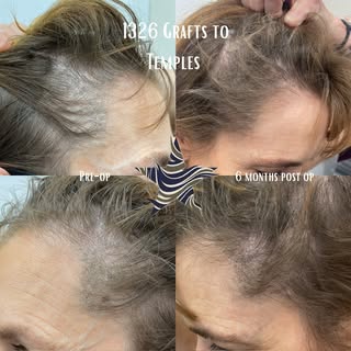 Ladies get hair transplants too! Our patient here had thinning in the temples which is common for so