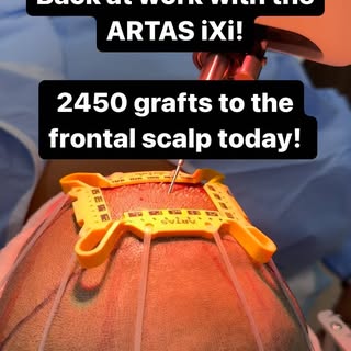 2450 grafts being harvested with our ARTAS iXi today here in the office! These new grafts are going 