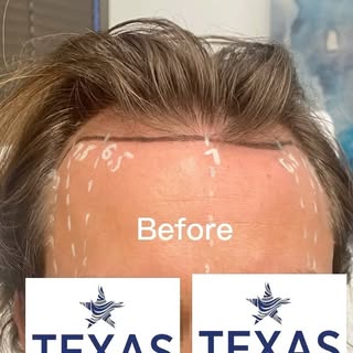 2250 grafts to the front hair line can make a big difference! Our patient today is 9 months out with