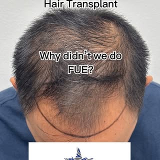 Our patient today came to us to see if we could help him achieve his goals of having more hair in th