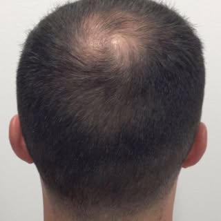 A lot can change in 6 months! We did 1500 grafts to the crown region along with PRP injections the d