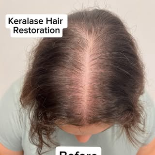 Thinning hair treatments don’t always have to be surgical. Our patient here wanted to improve the de