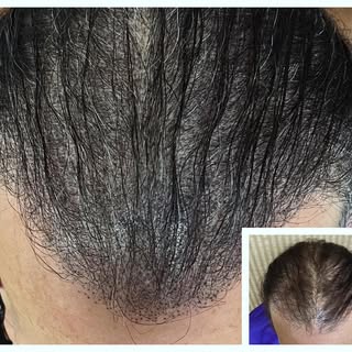 Some clients don’t want to shave their hair…ever!  If so we can add some density to minimize the whi