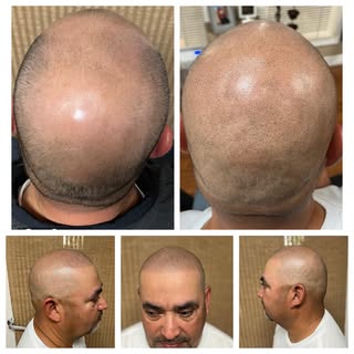 Never retouched. No filters or edits. Just realistic expectations for SMP from North State Scalp Cen