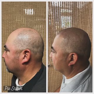 SMP can bring back your confidence!  Don’t settle for hair loss that brings down your confidence, wi