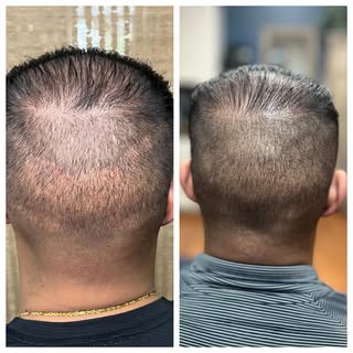 One Session SMP hair transplant scar treatment. Un-retouched and not finished YET!  North State Scal