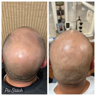 Unedited!  SMP changes how you feel about your hair loss. We hear it a lot “I love this, I wish I ha