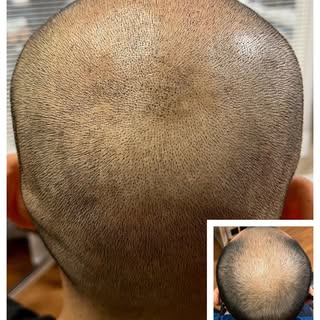 Who is ready to feel more self confident?  Ready to lose the hat? Ready to look younger?  It starts 