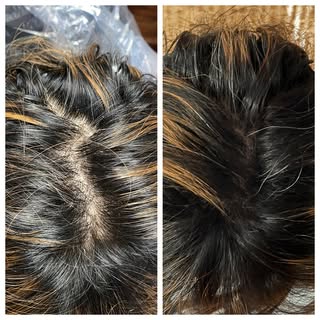 Our work UN-TOUCHED! What a difference high density SMP can make for female hair loss. #SMP #smpchic