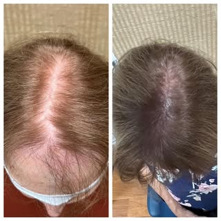 Density treats help to stop the scalp from “showing through” the hair. They are great alternatives f