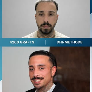 Heute, 10 Monate nach seiner Haartransplantation, spricht Aiman von einem Ergebnis, das seine Erwart