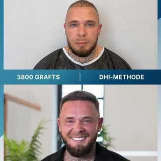 9 Monate nach seiner Haartransplantation gibt @liikeez ein Update zu seinem Ergebnis.

Bei Daniel wu