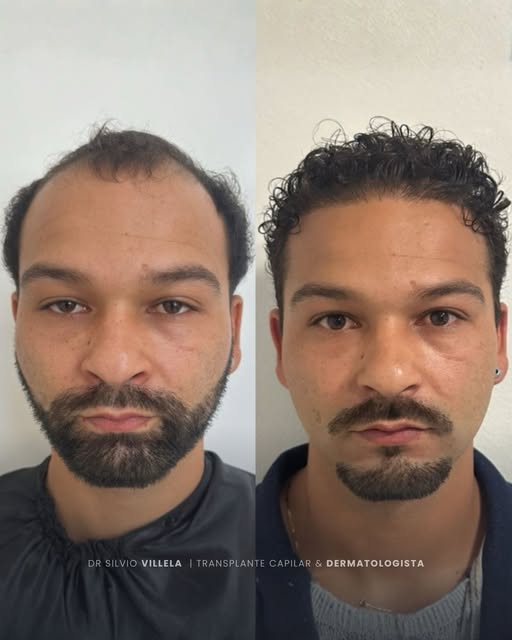 Tem mudanças que vão muito além do cabelo.

Recuperar a linha capilar e a densidade pode mudar a for