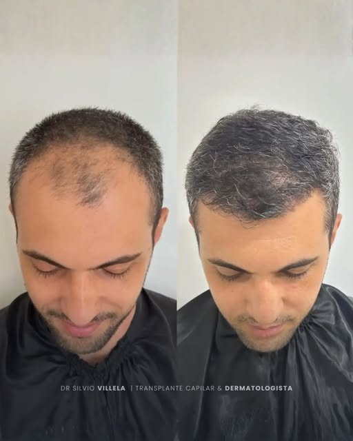 O transplante capilar não é apenas sobre preencher áreas com menos cabelo. 

É sobre devolver propor