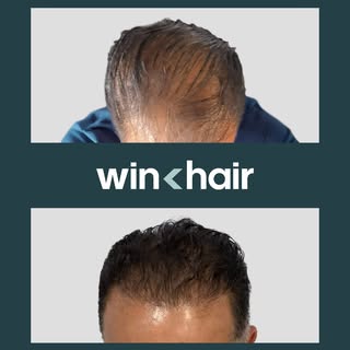 Changes you can see and feel. Start your journey at WinHair and rediscover yourself.

#beforeandafte