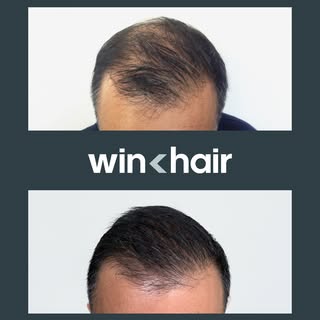 Hair transplantation is also a form of self-care. You'll look and feel rejuvenated.

Make the most i