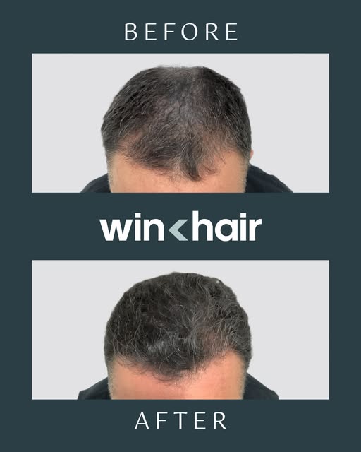 Let's bring back your confidence and hair at the same time.
Ready to take the next step? DM us to re