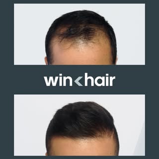 Imagine waking up, looking in the mirror, and no longer seeing those bald spots. With WinHair, it's 