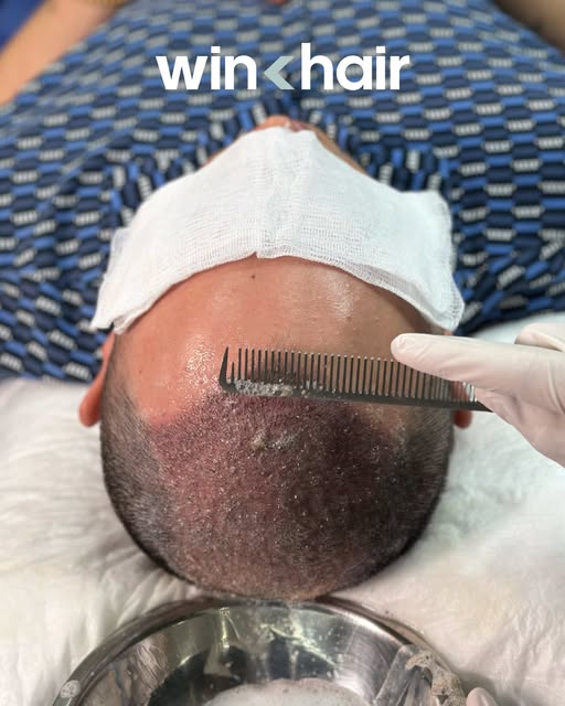 Scabs removal is one of the key parts after your procedure. Let us do it for you.
At Winhair, we tak
