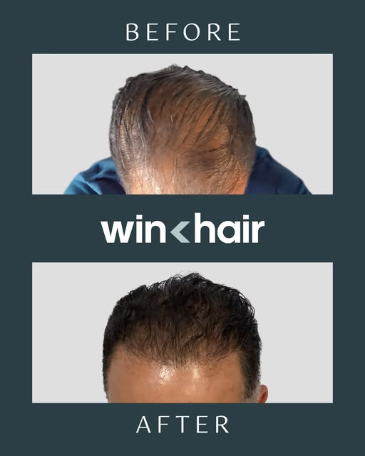 There are changes that need to be celebrated. Winning hair is one of them.
DMs are open for your quo