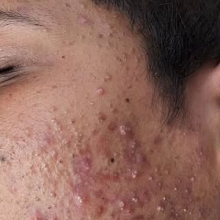 Pimples Se Pareshan?

With the availability of the finest medicines, creams and procedures like come