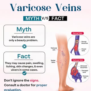 Myth: Varicose veins are only a cosmetic issue. ❌

Fact: They can cause aching, heaviness, swelling,