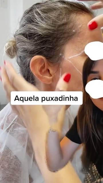 Você conhece essa técnica de Lifting Temporal com fios Definitivos e sem cortes ? 

Ele promove essa