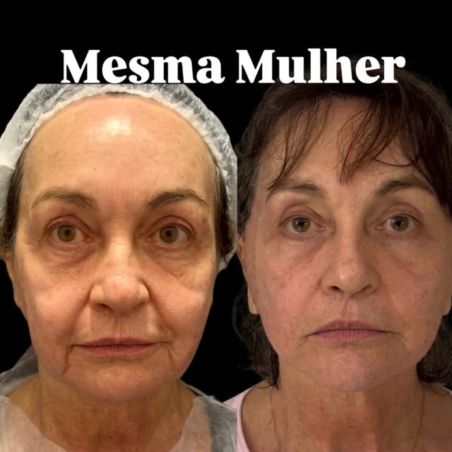 O rejuvenescimento facial exige uma abordagem planejada, unindo o reposicionamento estrutural dos te
