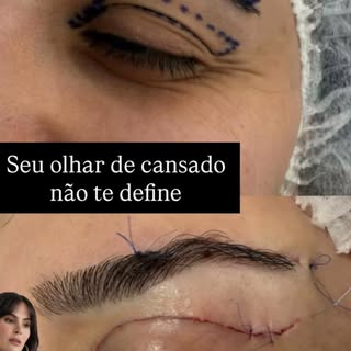 #blefaroplastia #olharcansado #blefaroplastiaribeirãopreto #olhar #ribeiraopretosp 
Agende sua consu