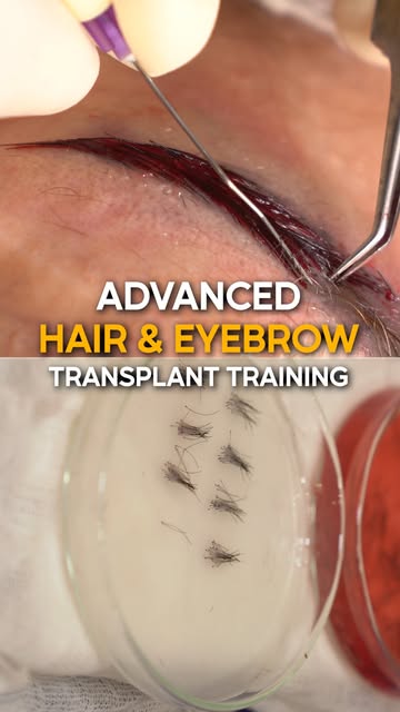 Advanced Hair & Eyebrow Transplant Training — Successfully Completed!
A successful 5-day hands-on tr