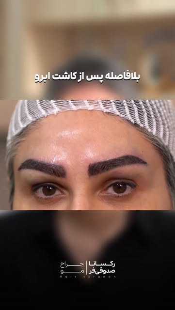 کاشت ابرو برای مراجعه کننده عزیزمون ✨️
_ _ _ _ _ _ _ _ _

• برای دریافت مشاوره و رزرو نوبت: 👇🏼
• @