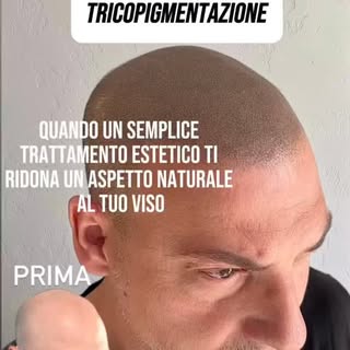 Da una calvizie completa a un risultato naturale, armonioso e realistico.
La Tricopigmentazione non 