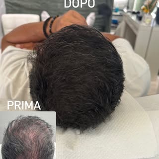 Effetto densità post trapianto di capelli terminato. 
Non sempre un operazione chirurgica come il tr