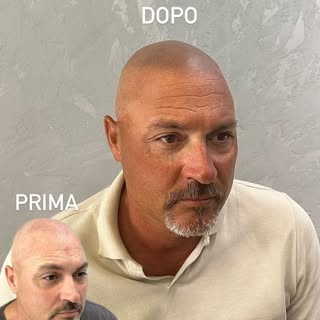 •Tricopigmentazione effetto rasato terminato•
📩 Se vuoi saperne di più invia un messaggio in Direct