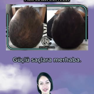 4 Seans PRP + 4 Seans Mezoterapi kampanyamız devam ediyor.

💉 Micro Optik Kameralı Saç analizi

💉4