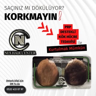 PRP destekli KÖK HÜCRE kampanyamız devam ediyor.

💉 Micro Optik Kameralı Saç analizi

💉 Microlyser