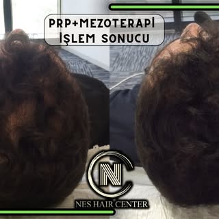 4 Seans PRP + 4 Seans Mezoterapi kampanyamız devam ediyor.

💉 Micro Optik Kameralı Saç analizi

💉4