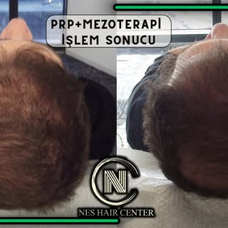 4 Seans PRP + 4 Seans Mezoterapi kampanyamız devam ediyor.

💉 Micro Optik Kameralı Saç analizi

💉4