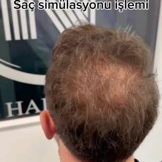 Vetteks Saç açıklığına yaptığım Saç simülasyonu çalışması.
Deyatlı bilgilendirme için dm den iletişi