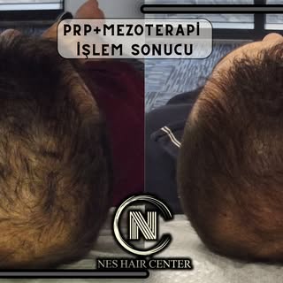4 Seans PRP + 4 Seans Mezoterapi kampanyamız devam ediyor.

💉 Micro Optik Kameralı Saç analizi

💉4