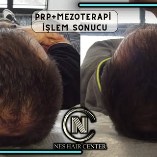 4 Seans PRP + 4 Seans Mezoterapi kampanyamız devam ediyor.

💉 Micro Optik Kameralı Saç analizi

💉4