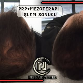 4 Seans PRP + 4 Seans Mezoterapi kampanyamız devam ediyor.

💉 Micro Optik Kameralı Saç analizi

💉4
