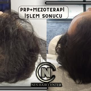 4 Seans PRP + 4 Seans Mezoterapi kampanyamız devam ediyor.

💉 Micro Optik Kameralı Saç analizi

💉4
