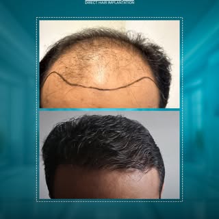 ما بين الماضي والحاضر… الفرق واضح
زراعة الشعر تمنحك إطلالة شبابية لا تُقاوم.

احجز استشارتك الآن في 