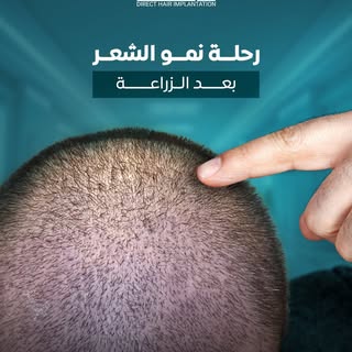 الدليل الزمني لرحلة شعرك الجديد 🕒
نتائج زراعة الشعر لا تظهر بين يوم وليلة، بل تمر بعدة مراحل طبيعية