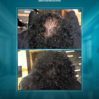 تحول حقيقي في وقت قياسي
زراعة الشعر تمنحك مظهرًا طبيعيًا ونتائج تدوم مدى الحياة.
في Tahseen Clinic ه