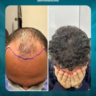 .
A new masterpiece of Hair Implantation at DHI Egypt ... where every detail creates a natural, time