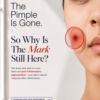 The pimple is gone, but the mark is still there. Why?

Not every dark spot left behind by acne is a 