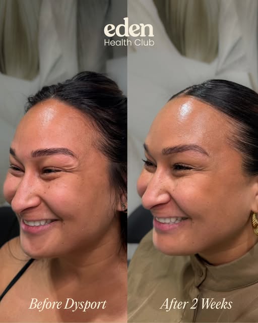 Another amazing before + after! ✨ 

Full-face Dysport correction: forehead, frown lines, crow’s feet