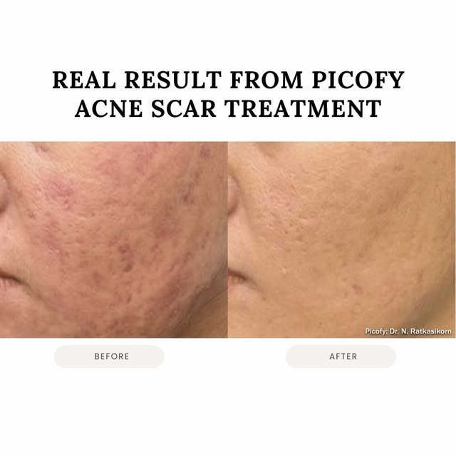 Real results. Real confidence. ✨

See the difference with Picofy Acne Scar Treatment—designed to imp